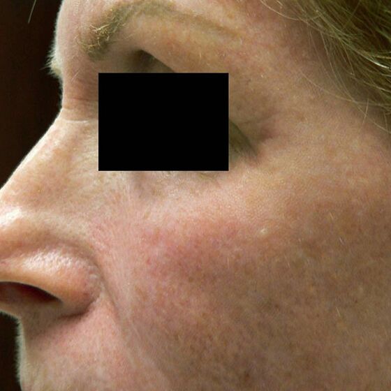 London Medical Spa - CO2 LASER RESURFACING 2/15/22. - Dr. Hal London Here  is another aggressive CO2 laser treatment of the face. This lovely patient  of mine asked me what would make