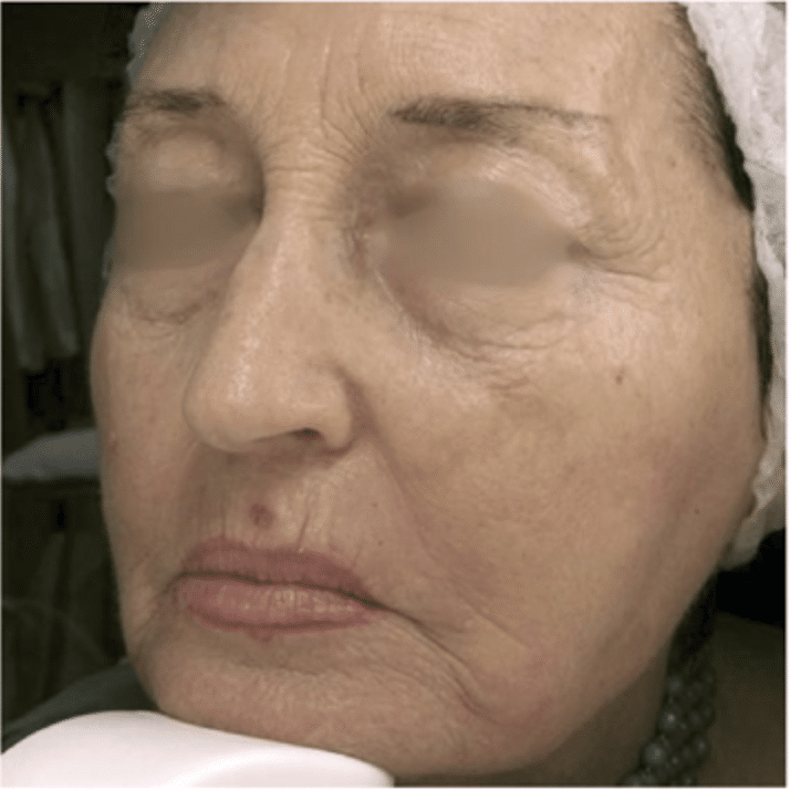 London Medical Spa - CO2 LASER RESURFACING 2/15/22. - Dr. Hal London Here  is another aggressive CO2 laser treatment of the face. This lovely patient  of mine asked me what would make