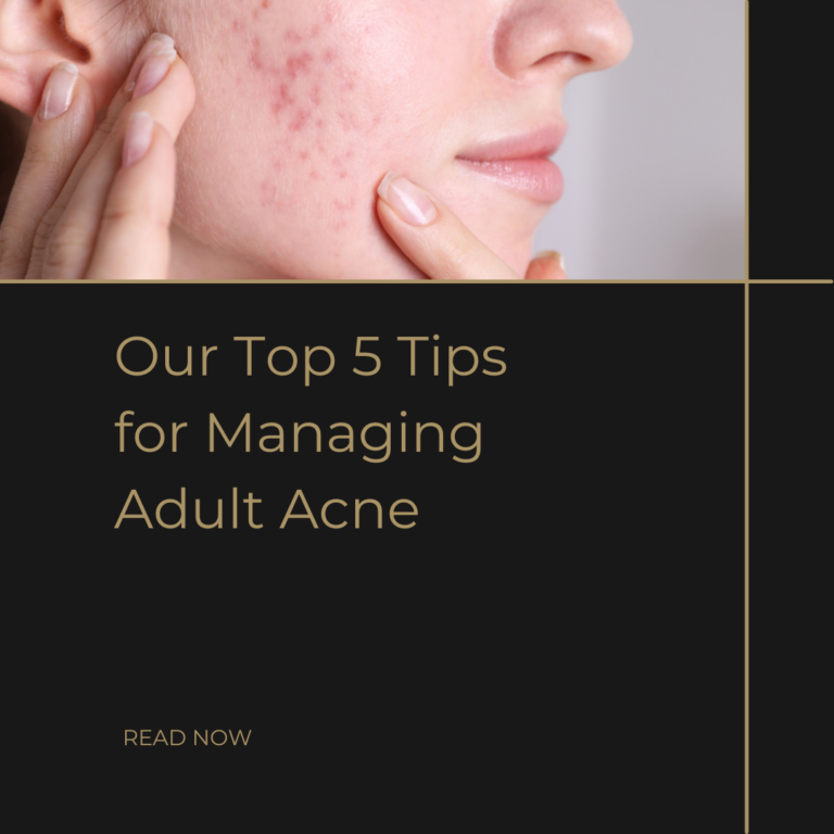 "Our Top 5 Tips for Managing Adult Acne" with an image of a woman with acne