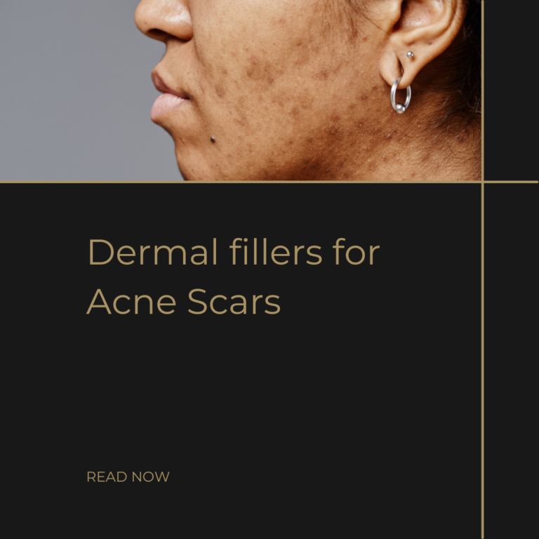 Dermal fillers for Acne scars