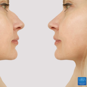 Dermal fillers in nose.